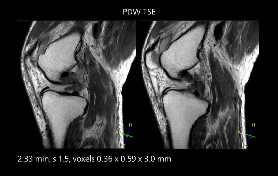 Knee mri two