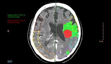 ct brain perfusion
