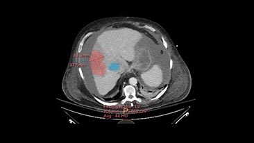 ct spectral tumor tracking