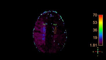 mr t2 neuro perfusion
